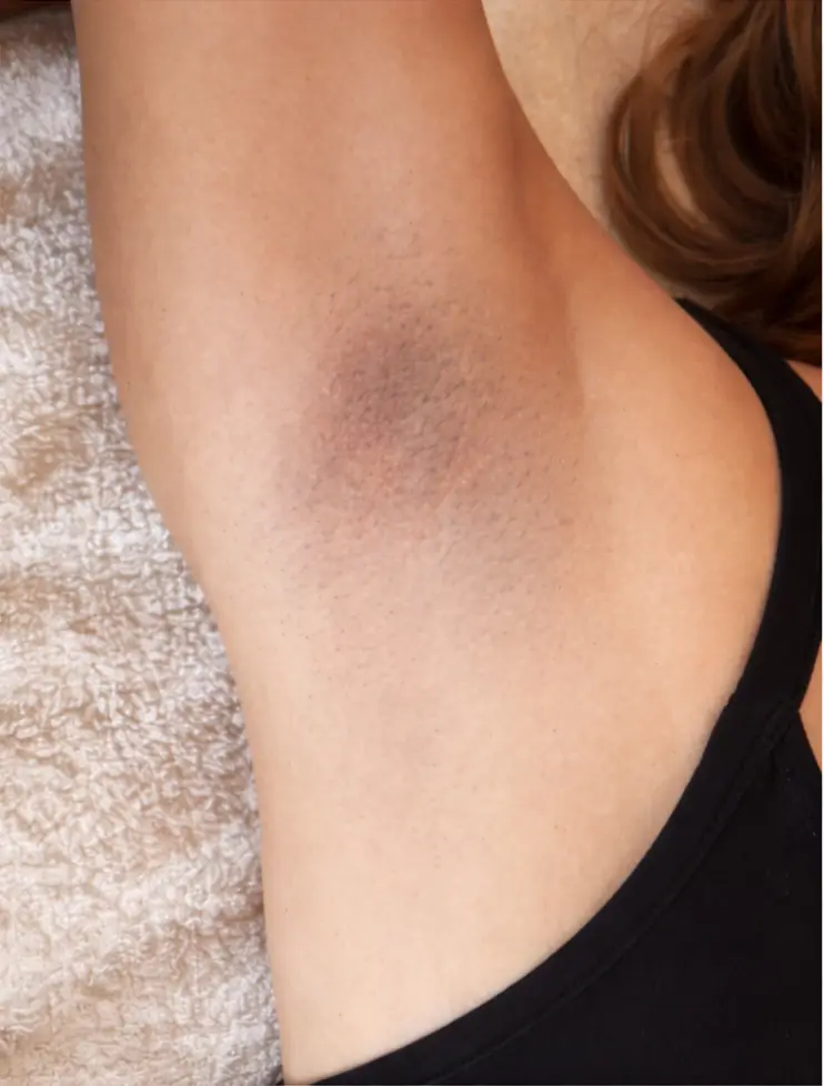 Na behandeling laserontharing op Curaçao