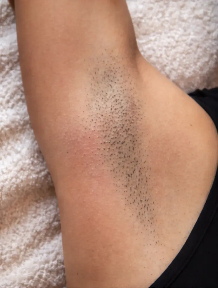 Voor behandeling laserontharing op Curaçao